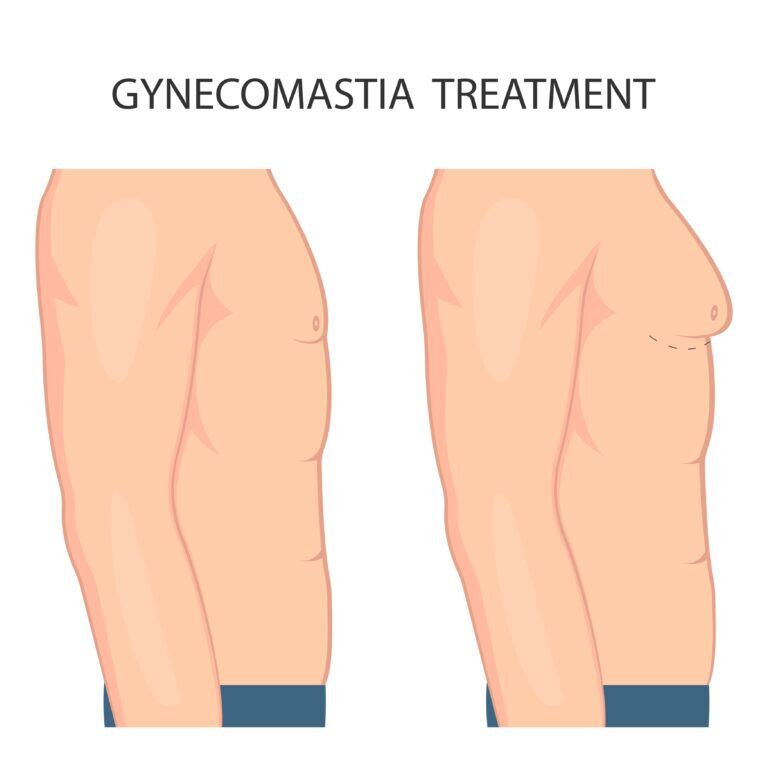 Gynecomastia vs. Chest Fat: What Are the Causes and How Do I Treat Each?