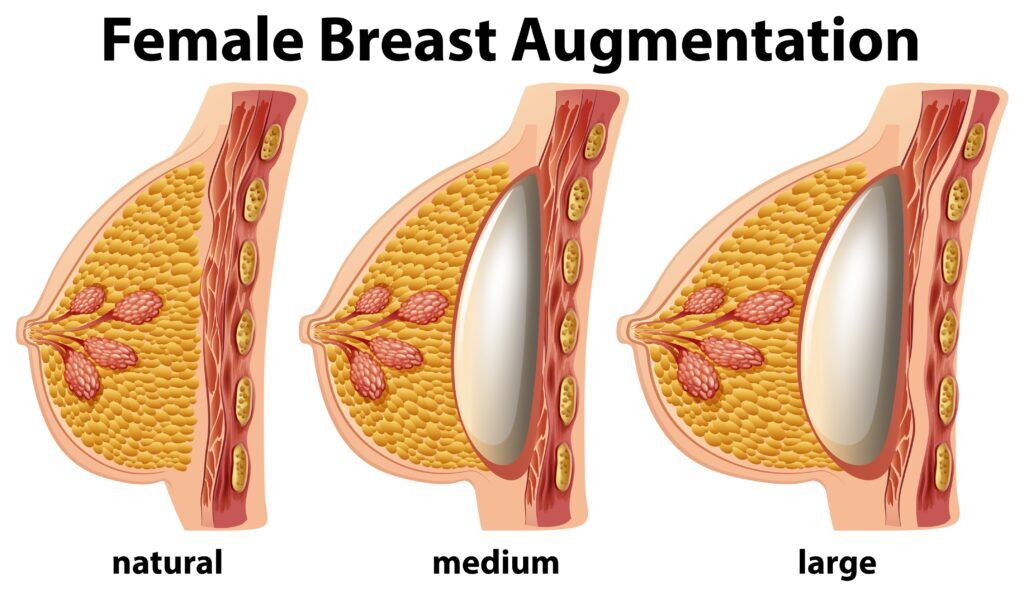 Breast Fat Transfer After 5 Years Breat Augmentation: What to Expect