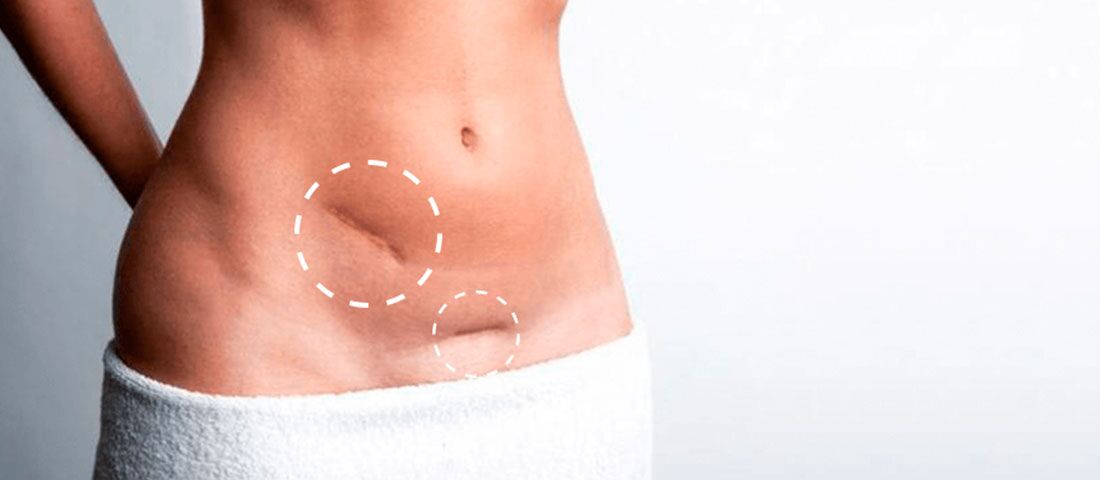 Tummy Tuck Scars – 15 Amazing Tummy Tuck Scars Removal Ways