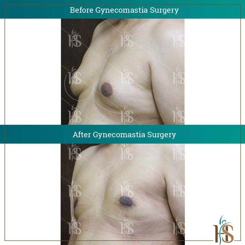 Gynecomastia in Dubai  Gynecomastia Surgery in Dubai